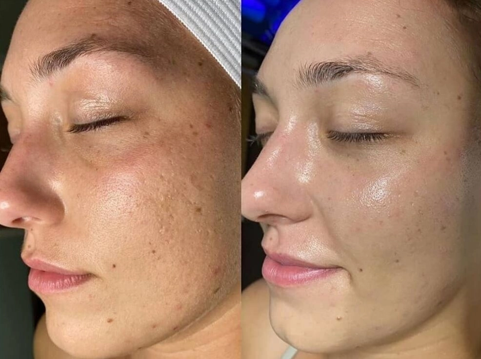 Before and after HydraFacial results at Etica Clinic