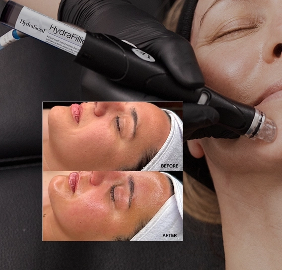 HydraFacial procedure and visible before and after results at Etica Clinic