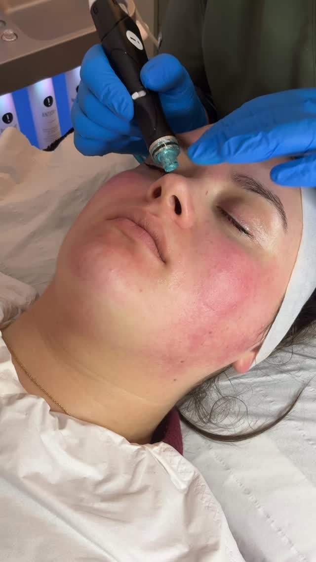 ✨ Say goodbye to clogged pores + blackheads!
HydraFacial deeply cleanses, exfoliates and extracts all the congestion your skin has been holding onto — leaving you smoother, clearer and glowing instantly.
There’s no downtime, just fresh, radiant skin… perfect for the festive season! 🎄✨
Book your HydraFacial now and get Christmas-ready with that flawless glow. ✨💆♀️
#HydraFacial #ClearSkin #BlackheadRemoval #CloggedPores #GlowingSkin #SkinGoals #FacialTreatments #SkincareClinic #SkinTransformation #HolidayGlow #ChristmasReady #FestiveSeasonGlow #HealthySkinJourney #LaserClinic #BeautyTreatment #SkinConfidence