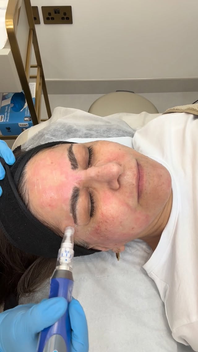 It’s SkinPen Microneedling season! ✨
Now is the perfect time to boost your collagen and get that glowing, glass-skin look just in time for the festive days ahead.
Black Friday Offer: 30% OFF
Now £136.50 (normally £195)
Glow starts now. ✨💫
#SkinPen #Microneedling #GlassSkin #GlowingSkin #CollagenBoost #FestiveGlow #SkinTreatment #SkinClinic #SkinCareDeals #BlackFridayOffer #SkinRejuvenation #HealthySkinJourney #RadiantSkin #SkinGoals #AestheticClinic