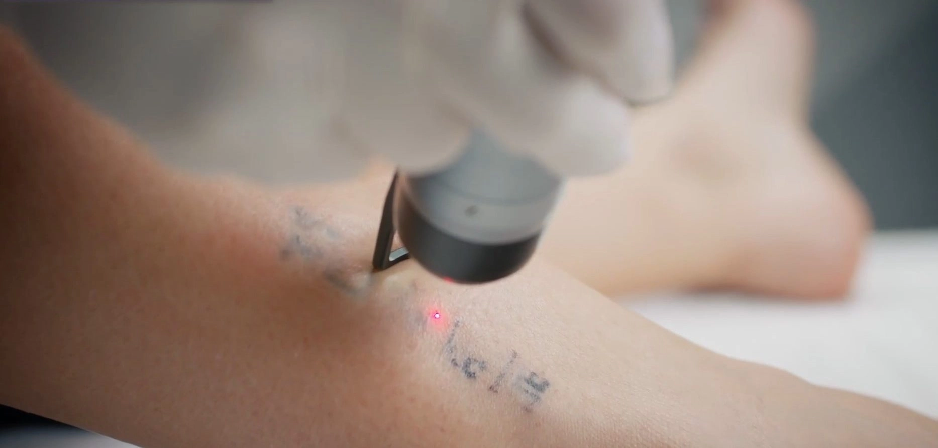 Close-up of laser tattoo removal treatment in progress at Etica Beauty Clinic