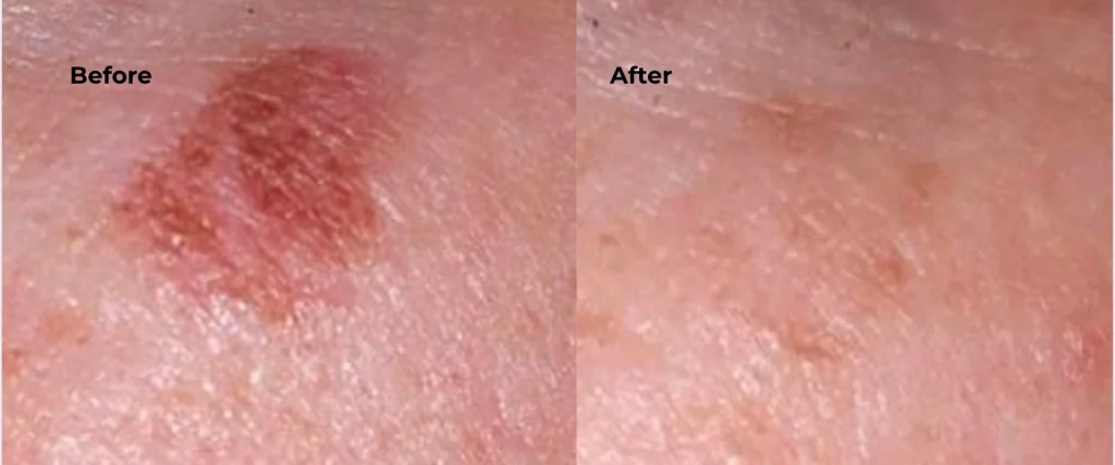Before and after cryosurgery image showing improved skin after benign lesion removal at Etica Clinic.