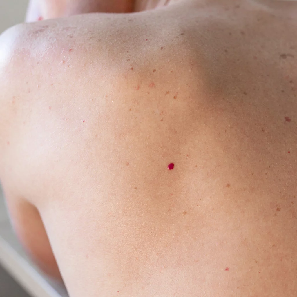 Close-up of a woman's upper back showing a red cherry angioma before electrolysis treatment.