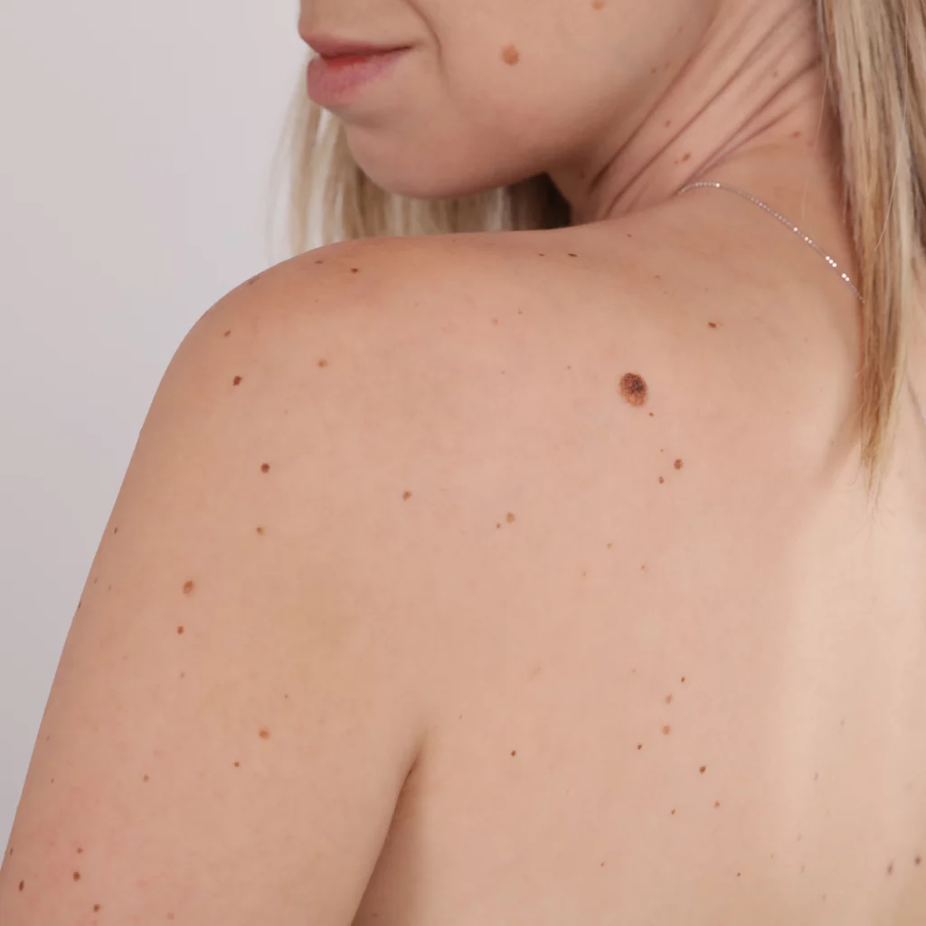 Back view of a woman with multiple moles and skin tags before electrolysis treatment.