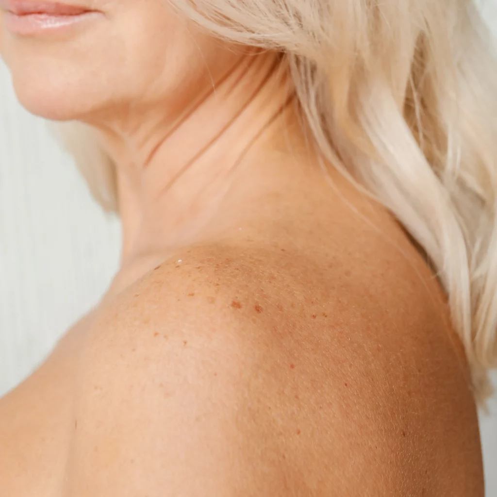 Close-up of a woman’s shoulder showing pigmentation before electrolysis treatment.