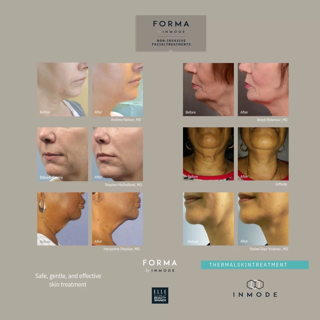 Before and after results of Forma RF skin tightening on jawline and neck at Etica Clinic Eastcote and Northwood.