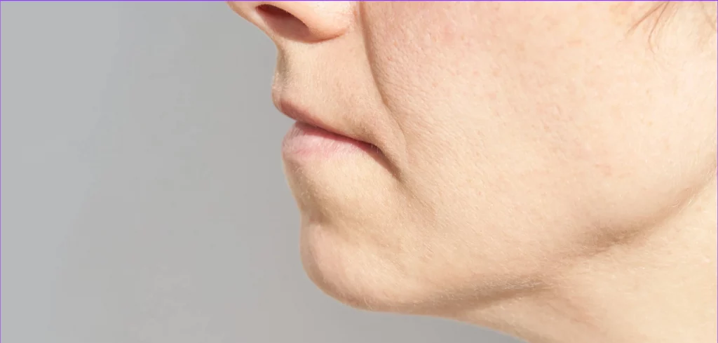 Close-up of jawline and lower cheek skin before Forma RF skin tightening treatment at Etica Clinic.