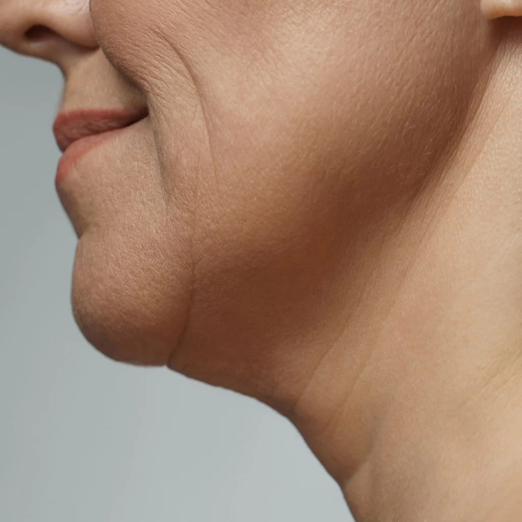 Close-up of lower face and jawline showing skin laxity before Forma treatment at Etica Clinic.