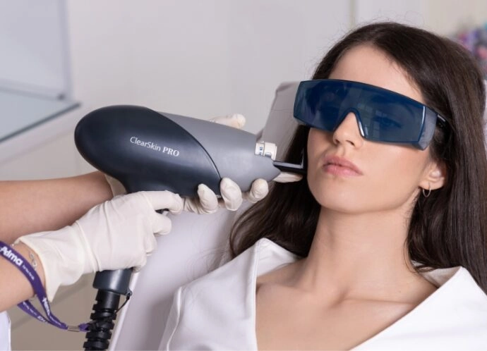 ClearSkin PRO laser treating acne-prone skin on the cheek at Etica Clinic.