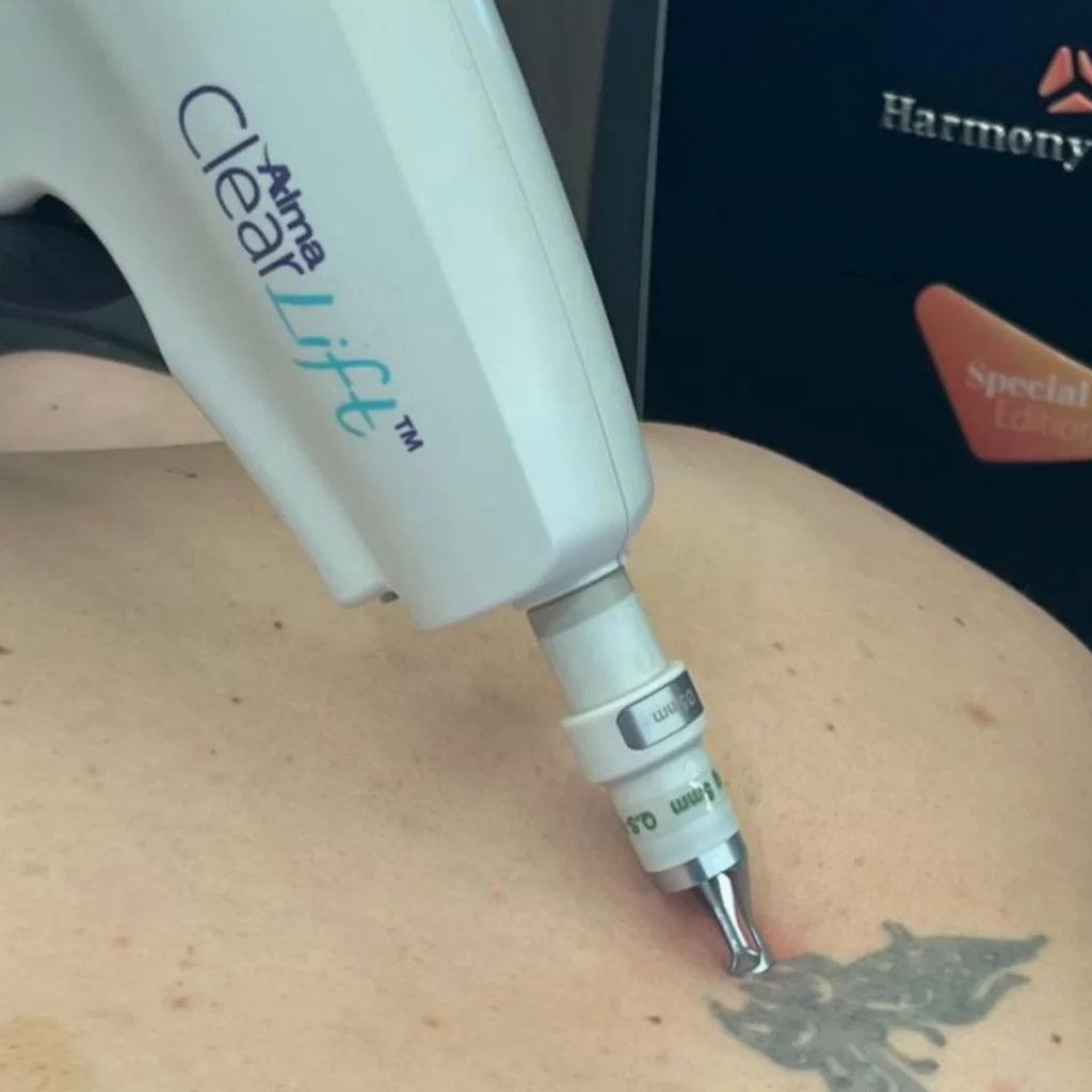 Laser tattoo removal using Alma ClearLift device at Etica Beauty Clinic