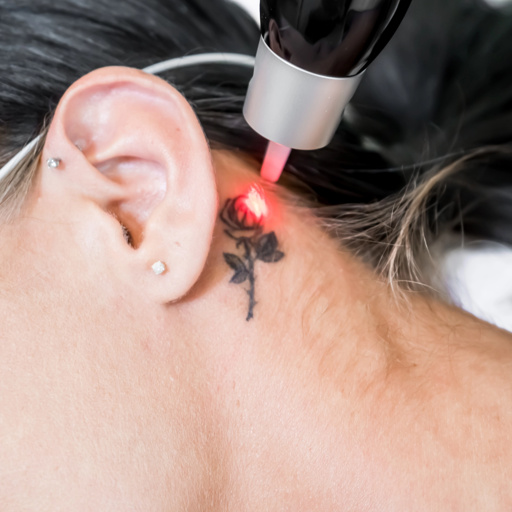 Laser tattoo removal in progress behind the ear at Etica Beauty Clinic