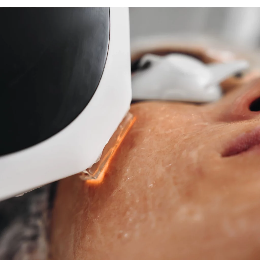 Close-up of Lumecca IPL treatment on a patient's cheek at Etica Clinic.
