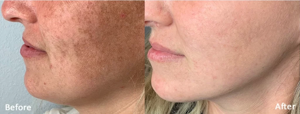 Before and after Lumecca treatment for pigmentation on female patient's cheek.