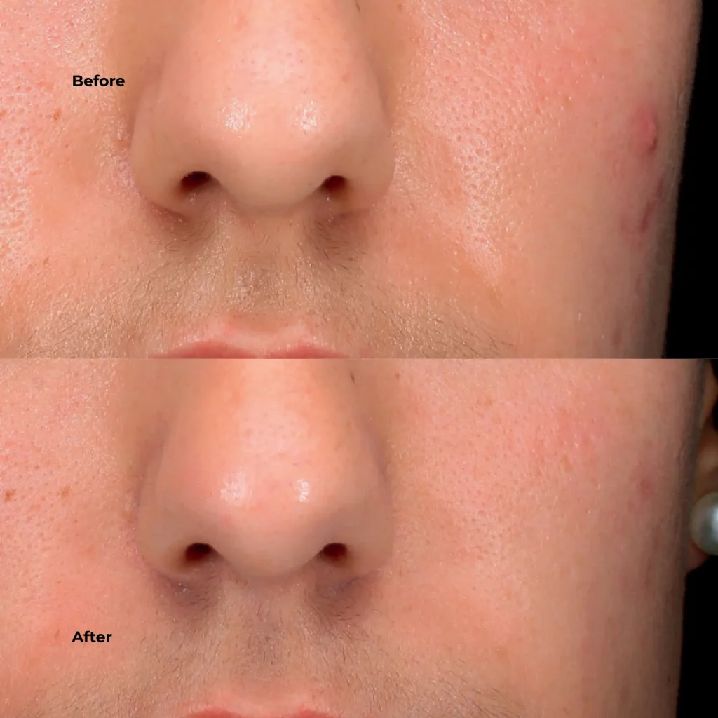 Before and after image of acne treatment showing improved skin clarity around the nose and cheeks