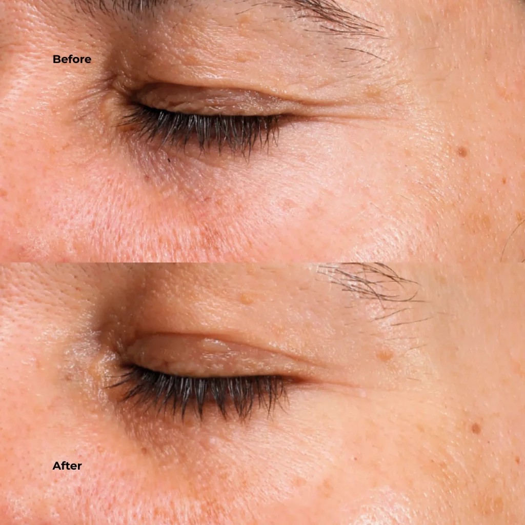 Before and after Mesoestetic Eyecon peel results showing smoother, brighter under-eye skin