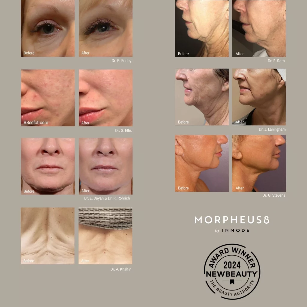 Grid of Morpheus8 before and after treatment results by various doctors, showing facial and neck rejuvenation.
