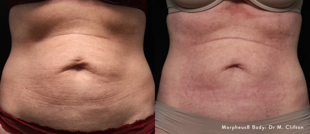 Before and after results of Morpheus8 Body treatment on the abdomen, reducing laxity and improving texture.