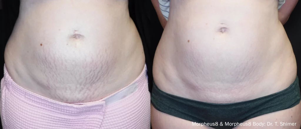 Before and after Morpheus8 Body treatment on the lower abdomen by Dr T. Shimer, addressing skin laxity and stretch marks.