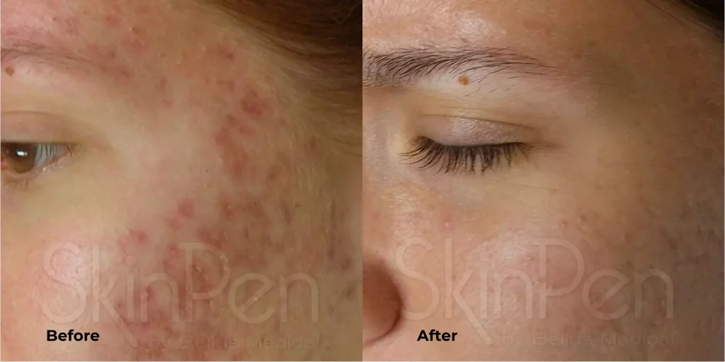 Before and after results of SkinPen microneedling for acne scars at Etica Clinic.