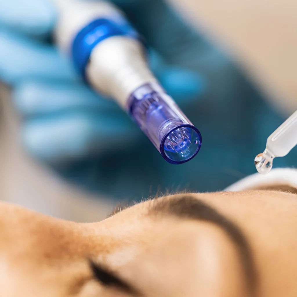 How it works SkinPen Microneedling treatment at Etica Beauty Clinic