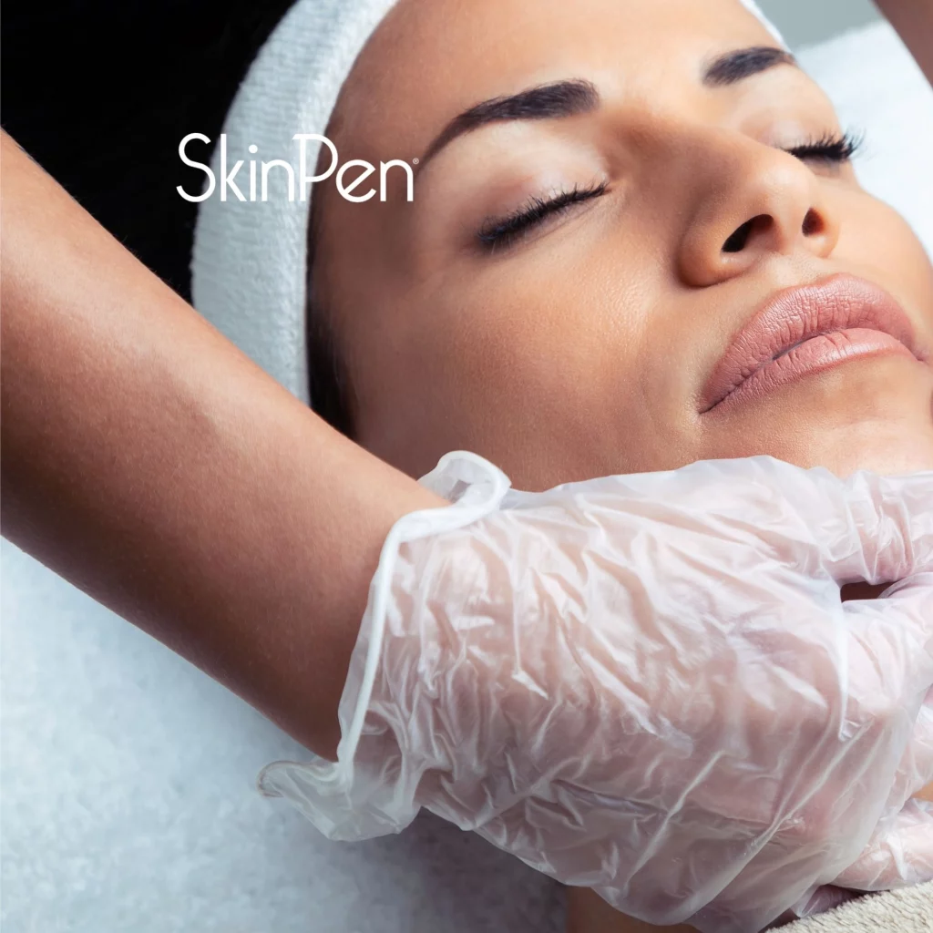 SkinPen microneedling treatment at Etica Beauty Clinic in Eastcote
