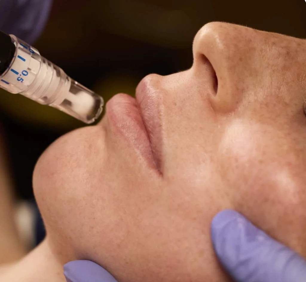 Close-up of SkinPen microneedling treatment being performed on a client's lower face at Etica Clinic.