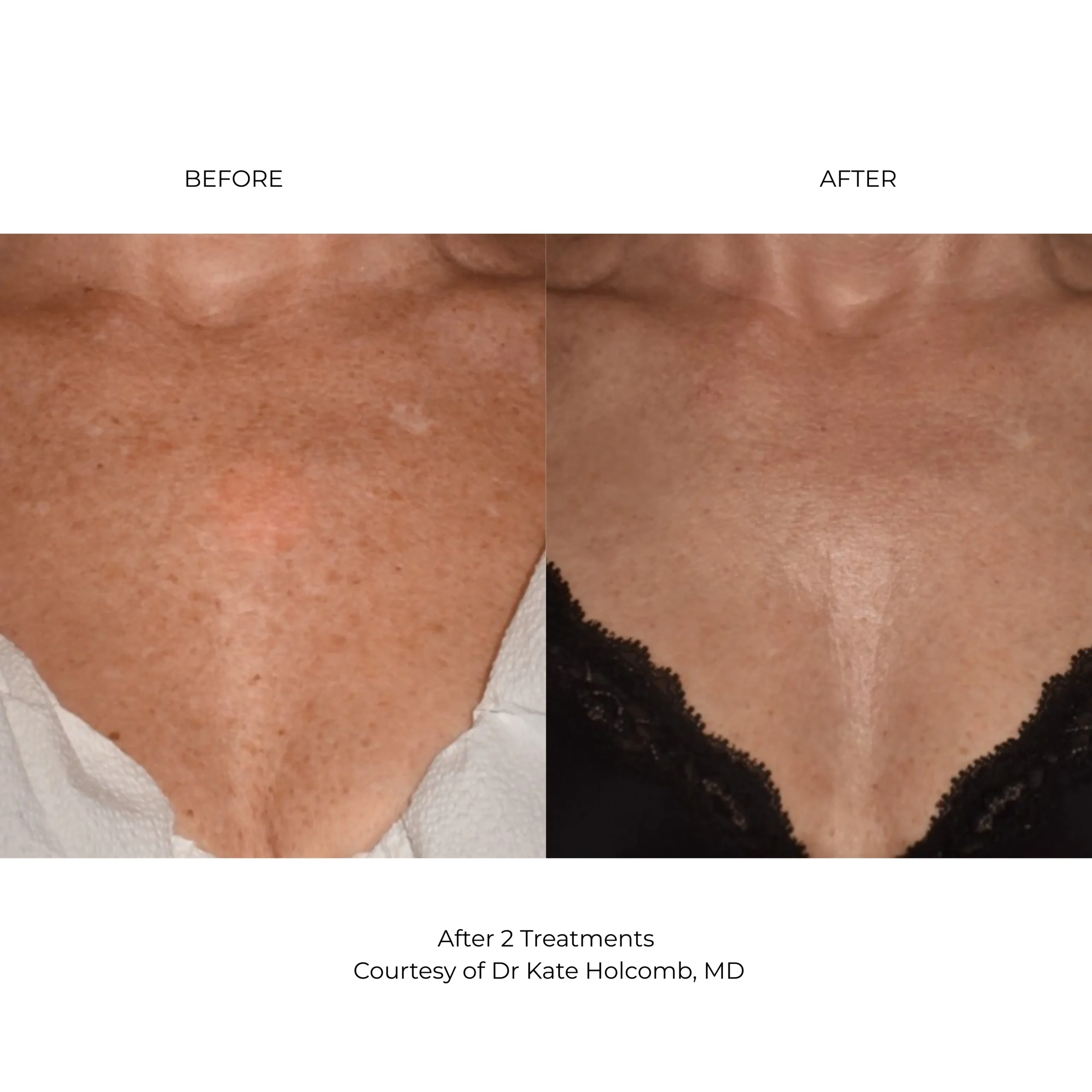 LaseMD Ultra before and after results reducing fine lines and improving skin quality at Etica Clinic