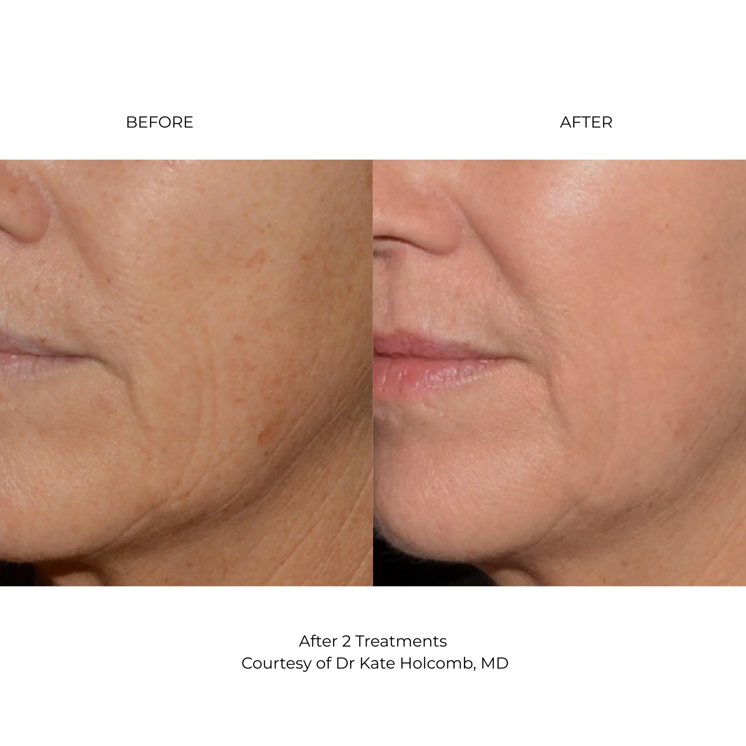 LaseMD Ultra before and after results showing improved pigmentation and skin tone at Etica Clinic