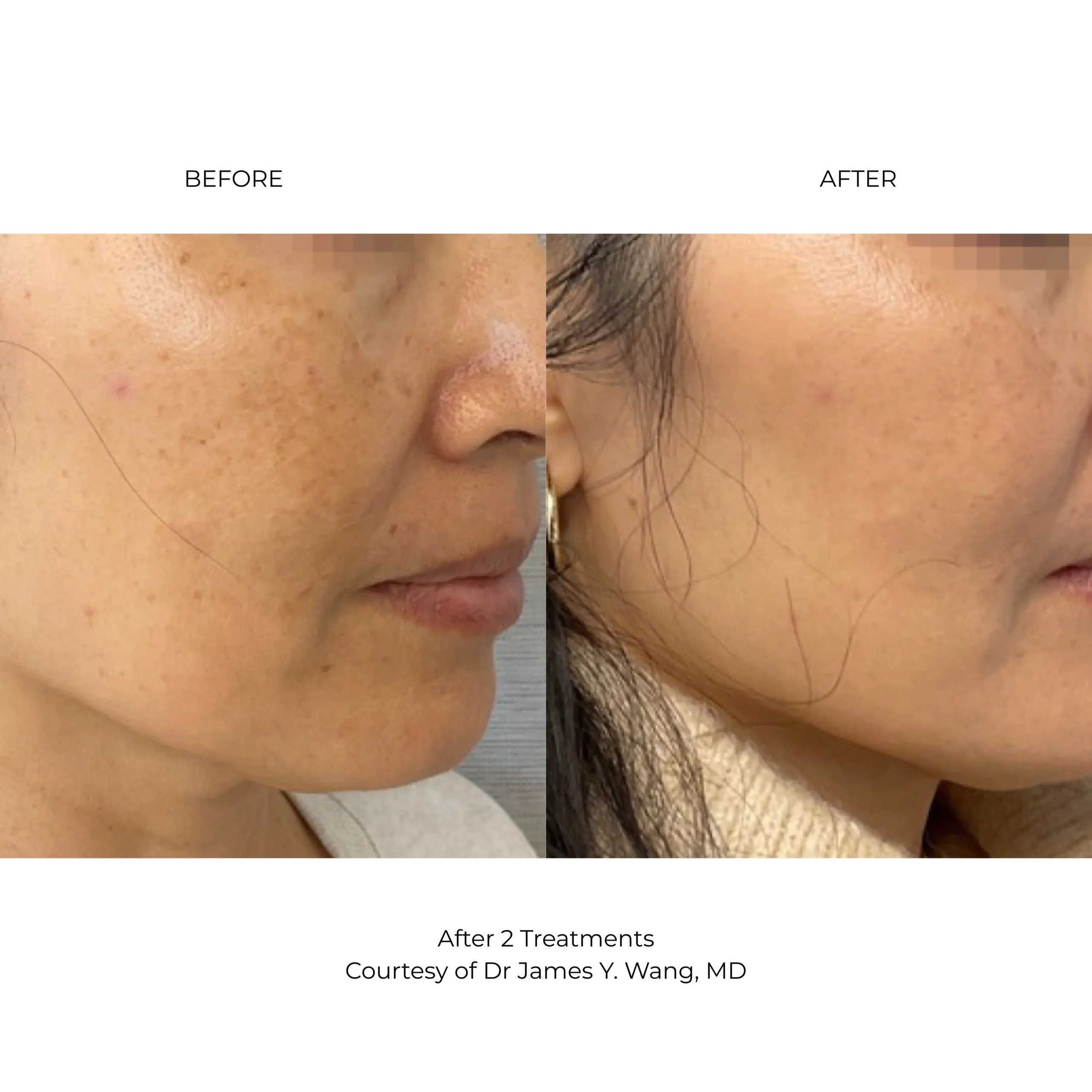 LaseMD Ultra before and after results improving skin texture and brightness at Etica Clinic